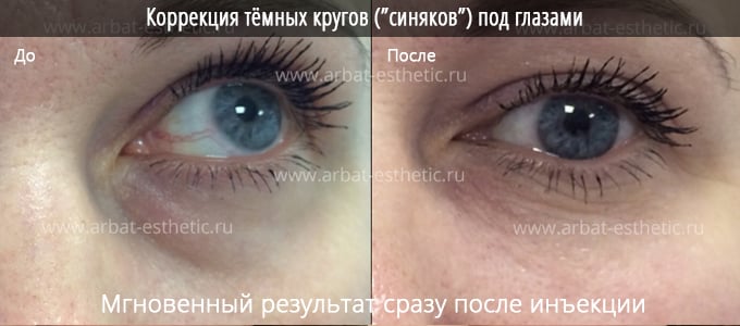 Как убрать синяки и темные круги под глазами у мужчин и женщин | Клиника “Elevans”
