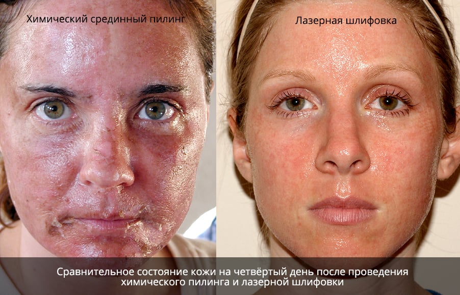 выравнивание кожи лица пилинги или лазер thumbnail