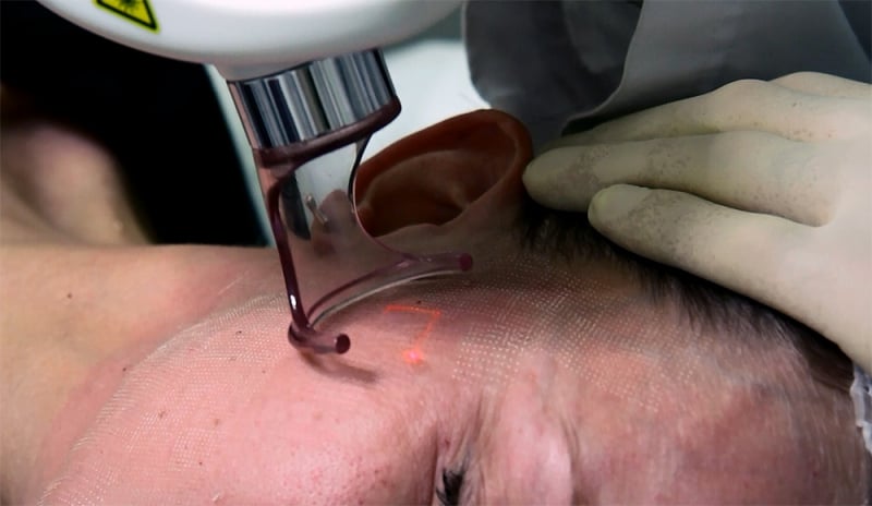 Лазерный пилинг лазерная шлифовка кожи лица